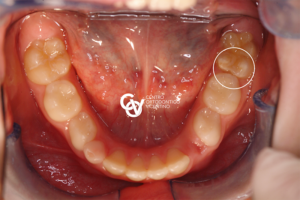 MHI - Ipomineralizzazione dello smalto dentario