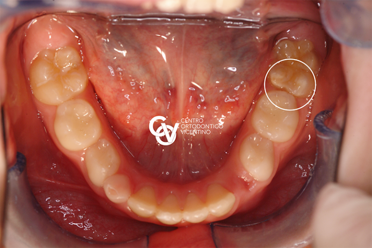 MIH or hypomineralization of incisors and molars - Dentisti Vignato Vicenza