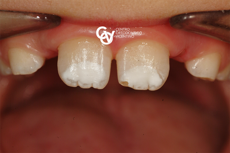 MIH o ipomineralizzazione di incisivi e molari Dentisti Vignato Vicenza