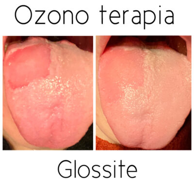 ozono terapia per glossite
