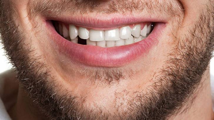 Perché sostituire un dente mancante