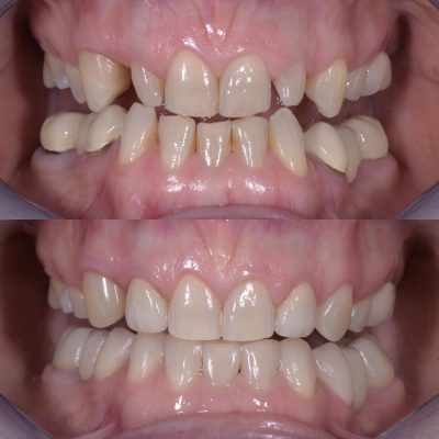 dentisti vignato_odontoiatria estetica_caso 1