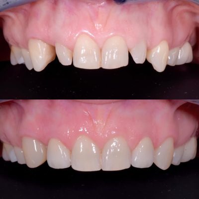 dentisti vignato_odontoiatria estetica_caso 2