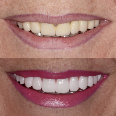 dentisti vignato_odontoiatria estetica_caso 3_faccette dentali