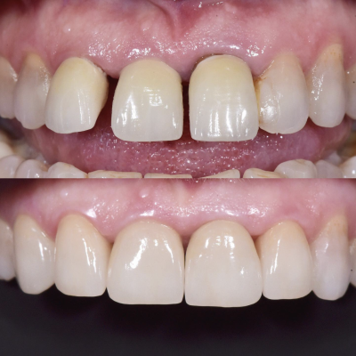 dentisti vignato_odontoiatria estetica_caso 4_corone singole e composito