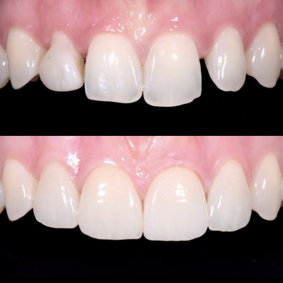 dentisti vignato_odontoiatria estetica_caso 5_faccette dentali_2