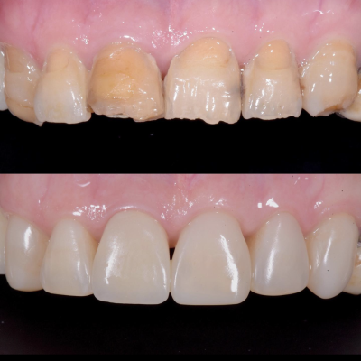 dentisti vignato_odontoiatria estetica_caso 6_composito corona