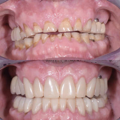 dentisti vignato_odontoiatria estetica_caso 7_faccette e compositi