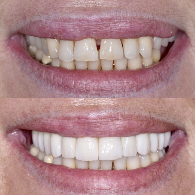 dentisti vignato_odontoiatria estetica_caso 8_protesi parziale a fissa su impianti