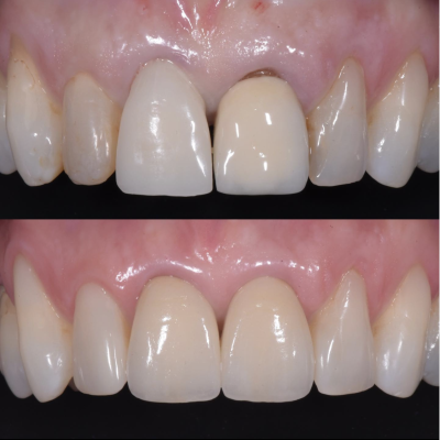 dentisti vignato_odontoiatria estetica_caso 9_corona e composito
