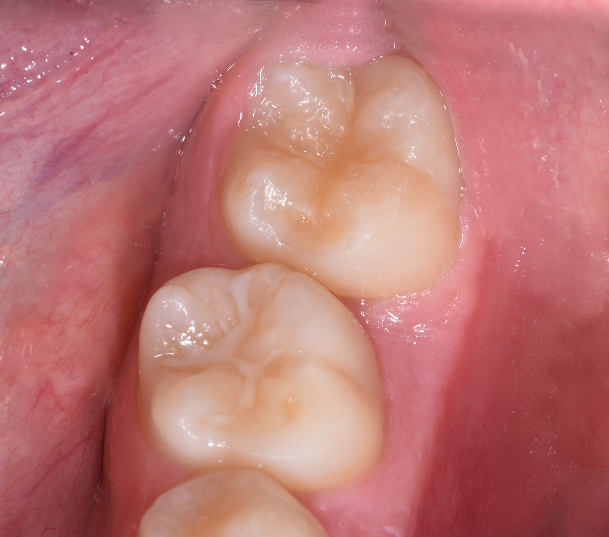 Materiale Restaurativo Dentale Temporaneo 40g – Sigillo Per Cavità, Cemento Idraulico A Indurimento Rapido - copertina